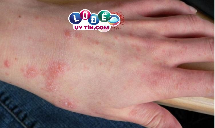 Nằm mơ thấy bị ghẻ lở là điềm gì? Đánh số nào? 29 Nằm mơ thấy bị ghẻ lở là điềm gì? Đánh số nào?
