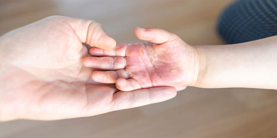 Nằm mơ thấy bị bỏng đánh lô như thế nào cho hợp lý? 26 Nằm mơ thấy bị bỏng đánh lô như thế nào cho hợp lý?